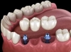Dental implant cost mckinney Avatar